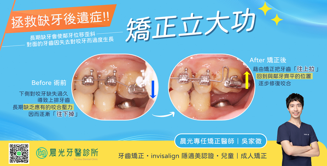 缺牙後遺症的完美逆轉