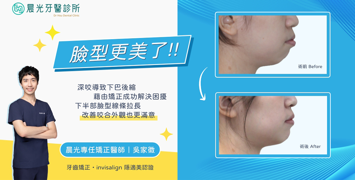 深咬矯正臉型