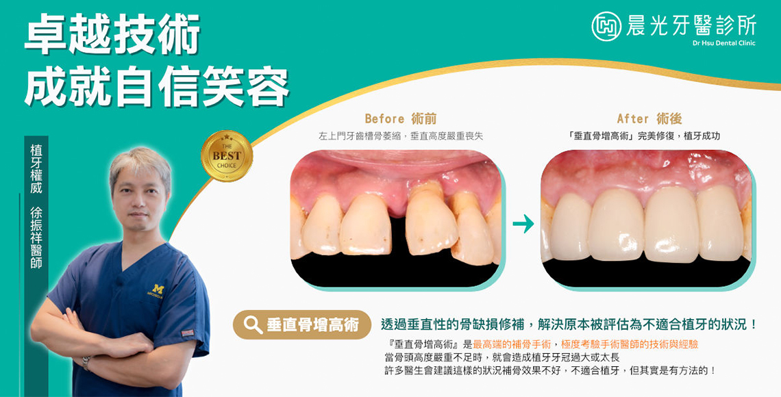 前牙垂直骨增高