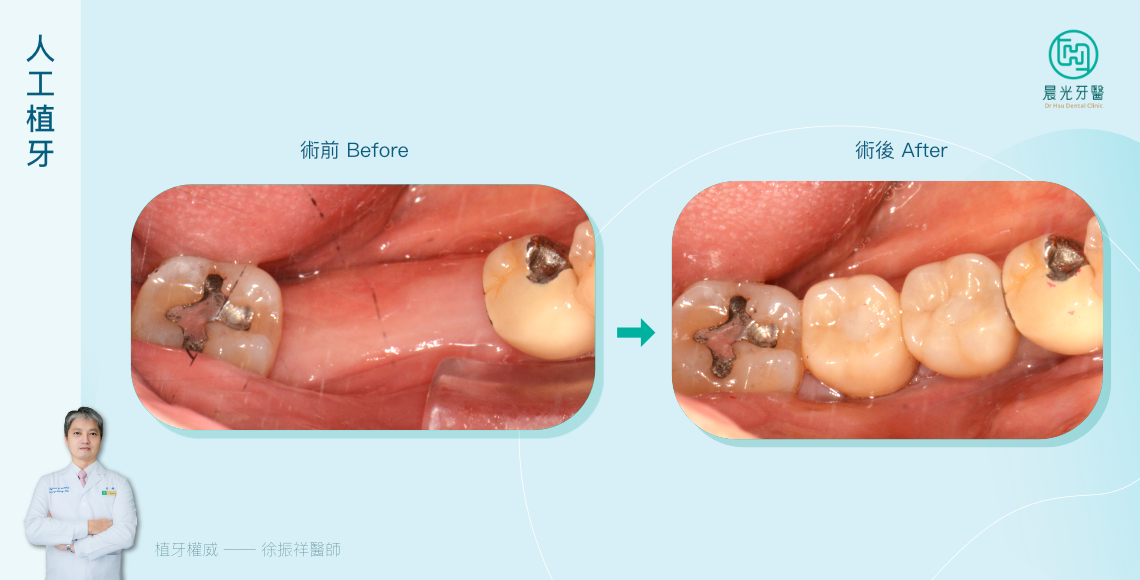 美學再升級，完美復原咬合