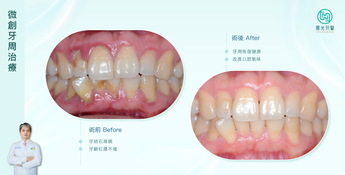 不容忽視，牙周治療的必要性