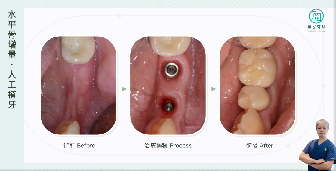 終於沒有少牙齒了