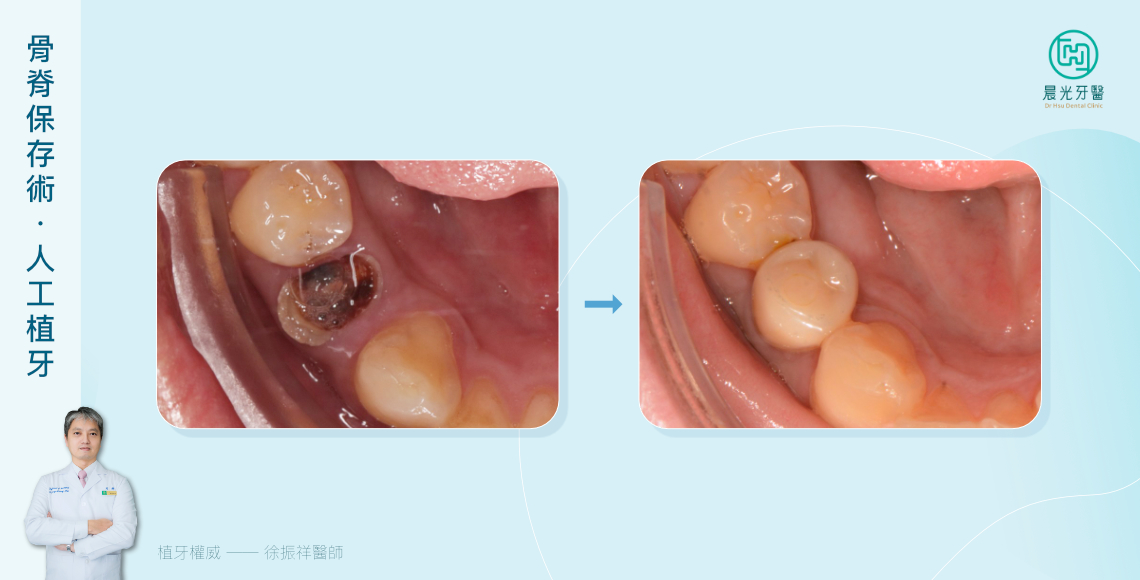 拔牙不是結束，是關鍵開始